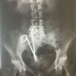 Medical Instrument Left in Situ after Abdominal Operation